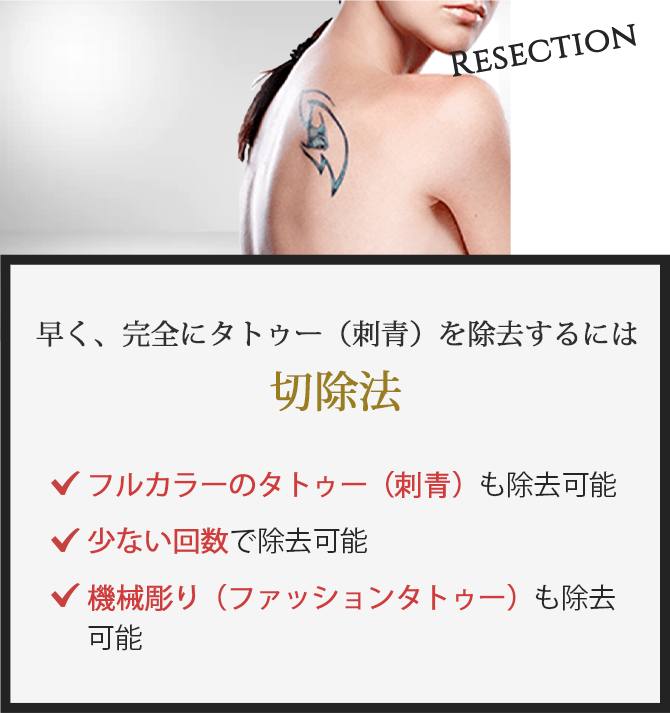 早く、完全にタトゥー(刺青)を除去するには切除法