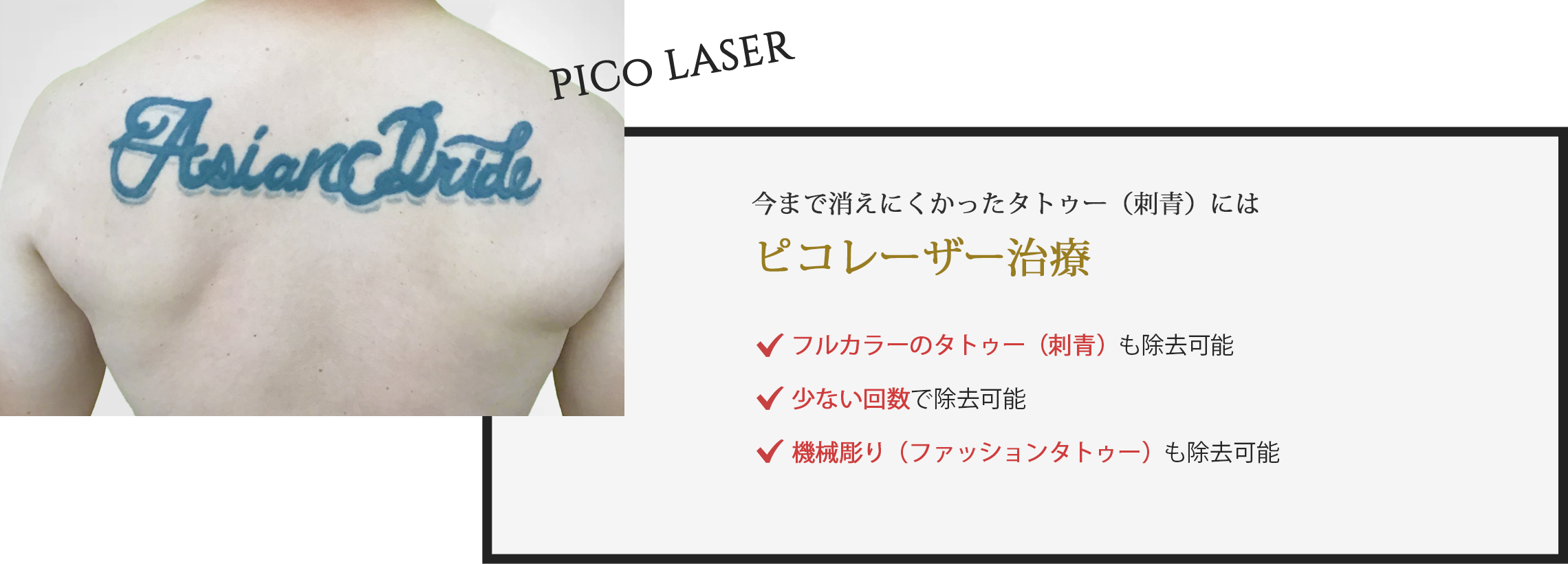今まで消えにくかったタトゥー(刺青)にはピコレーザー治療