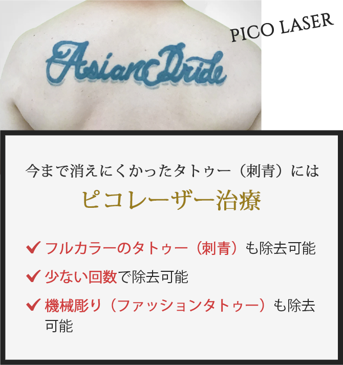 今まで消えにくかったタトゥー(刺青)にはピコレーザー治療